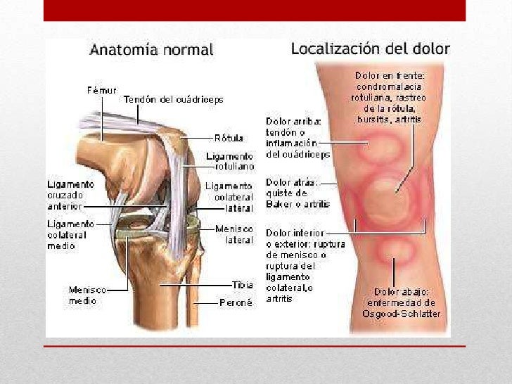 Dolor de artrosis de rodilla