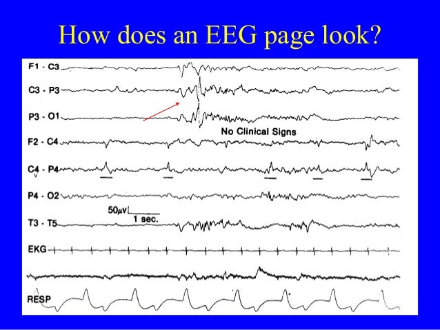 abnormal eeg normal vs epilepsy abnormal eeg normal vs epilepsy