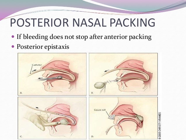Sinus strain no snot sinusitis groin pain