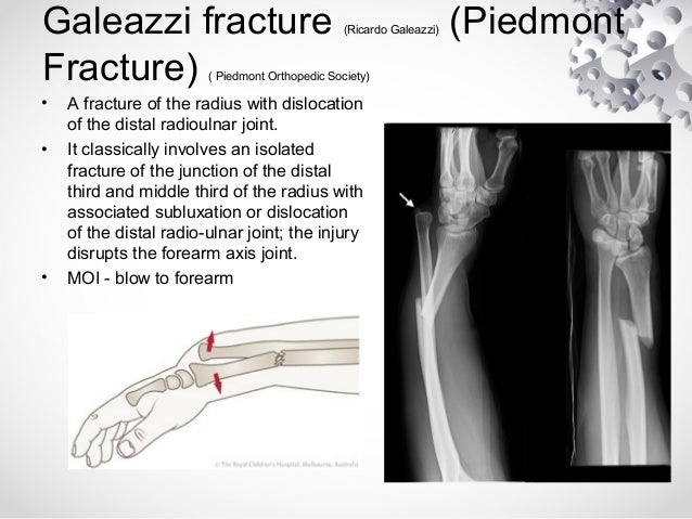 Eponymous fractures