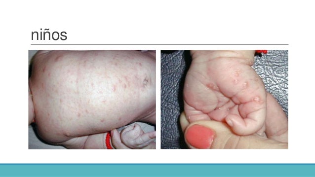 Si es posible determinar la psoriasis por la análisis de sangre