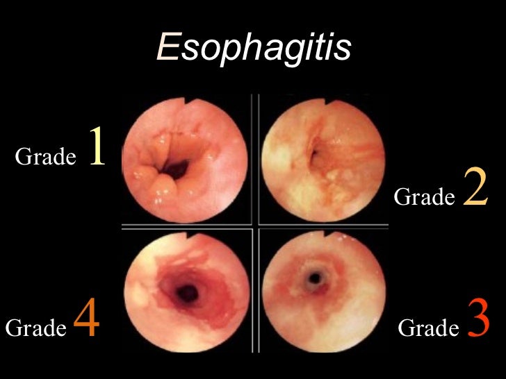 esophageal pathology 11 728