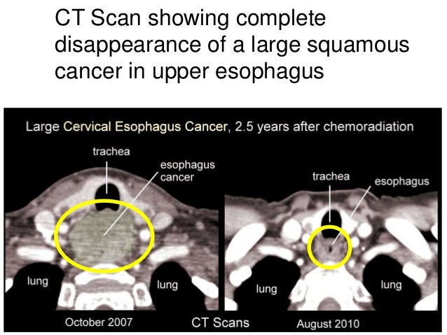 Radiation remedy cancer