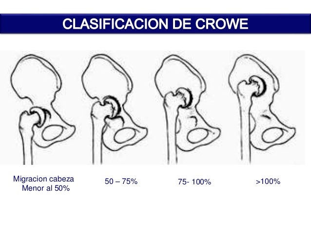 ESSALUD DISPLASIA DE CADERA EN EL ADULTO JOVEN