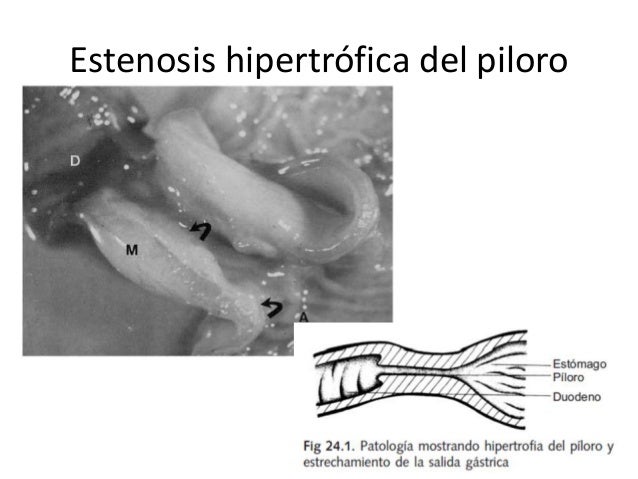 Estenosis hipertrófica del píloro