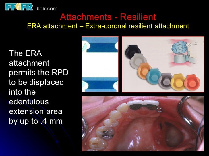 Esthetics, rotational path, attachments