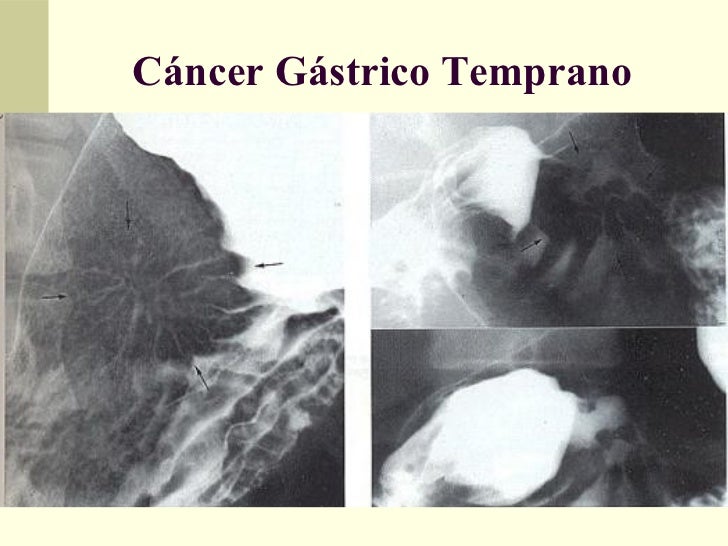 Frammenti Di Mucosa Gastrica Di Tipo Antrale E Fundico