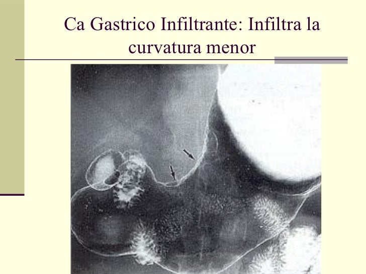 Frammenti Di Mucosa Gastrica Di Tipo Antrale E Fundico