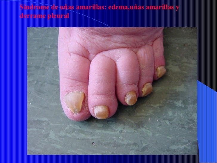 De que la psoriasis en el cuerpo y como curar