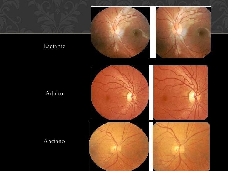 Examen de fondo de ojo
