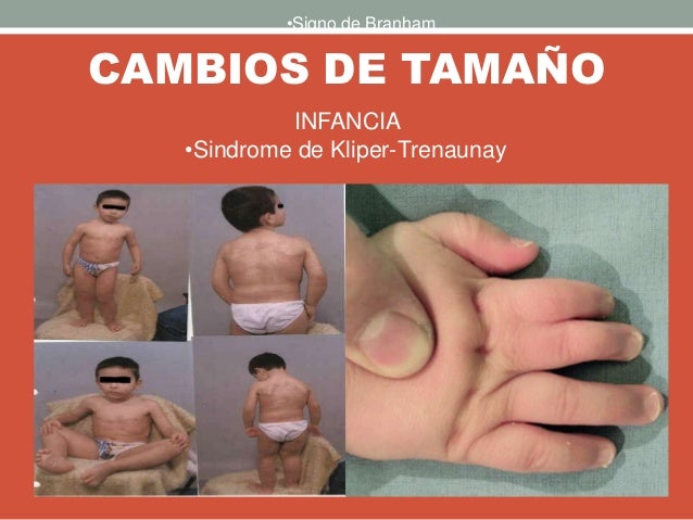 CAMBIOS DE TAMAÑO
INFANCIA
•Sindrome de Kliper-Trenaunay
•Signo de Branham
 