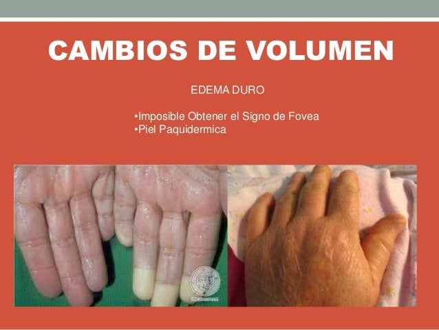 CAMBIOS DE VOLUMEN
EDEMA DURO
•Imposible Obtener el Signo de Fovea
•Piel Paquidermica
 