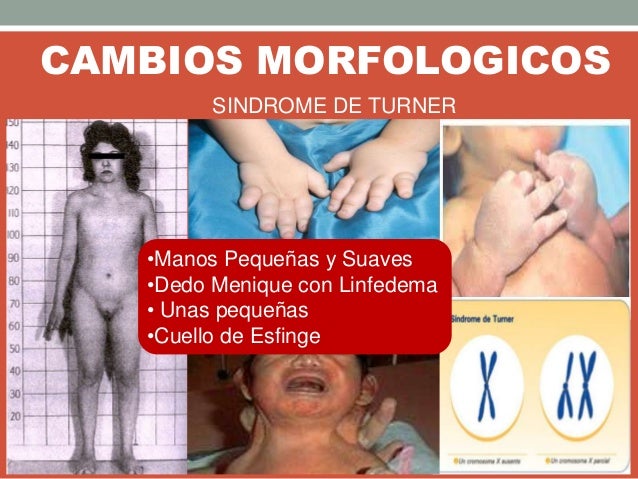 CAMBIOS MORFOLOGICOS
SINDROME DE TURNER
•Manos Pequeñas y Suaves
•Dedo Menique con Linfedema
• Unas pequeñas
•Cuello de Es...