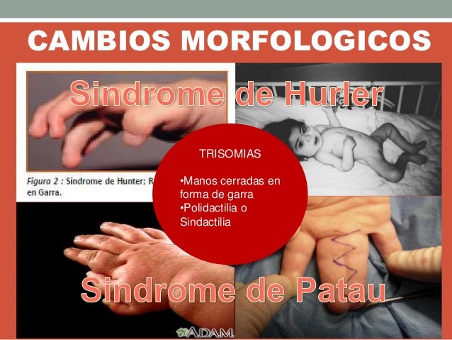CAMBIOS MORFOLOGICOS
TRISOMIAS
•Manos cerradas en
forma de garra
•Polidactilia o
Sindactilia
 