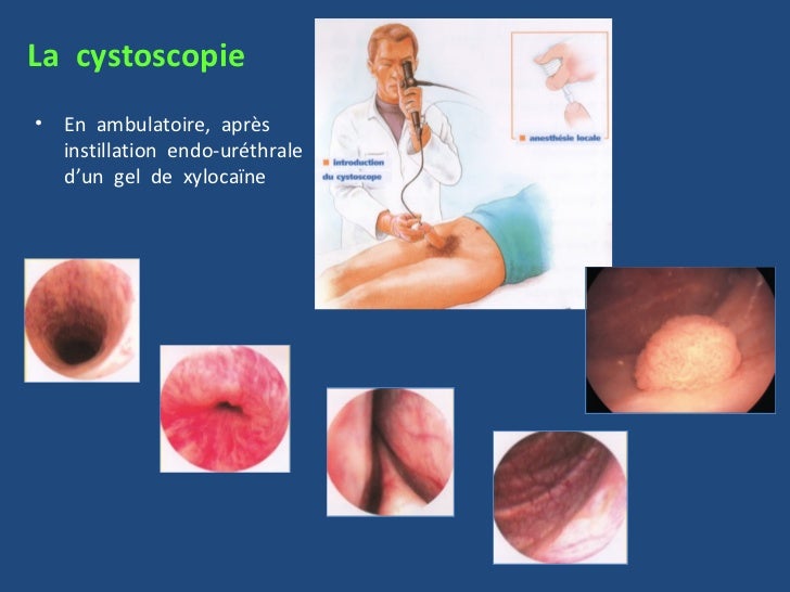 Cancer Du Rein Chirurgie