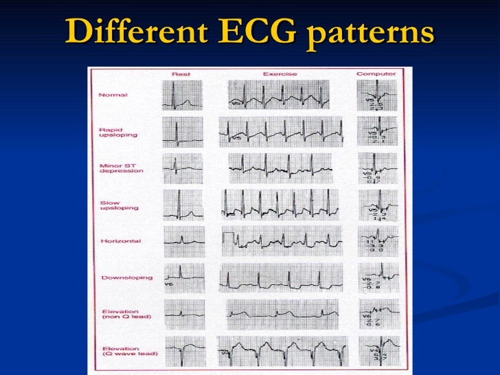 Exercise stress ecg. dmo