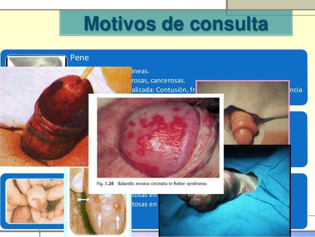 Las pequeñas ampollas en la cabeza del miembro