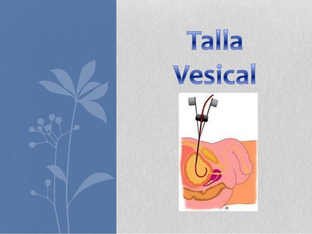 sondaje-vesical-y-talla-vesical