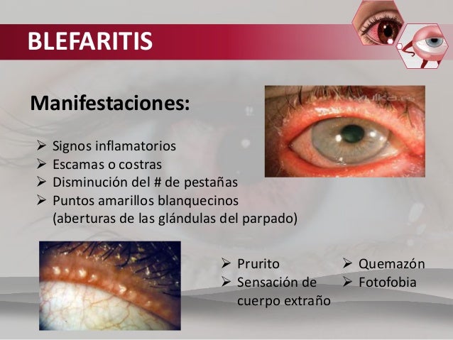Las arrugas menudas bajo los ojos en 30 años