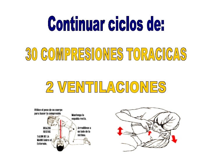 5 Ciclos De 30 Compresiones Por 2 Ventilaciones