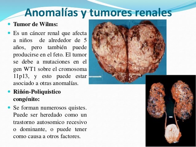 El tratamiento spondilodistsita del departamento de pecho