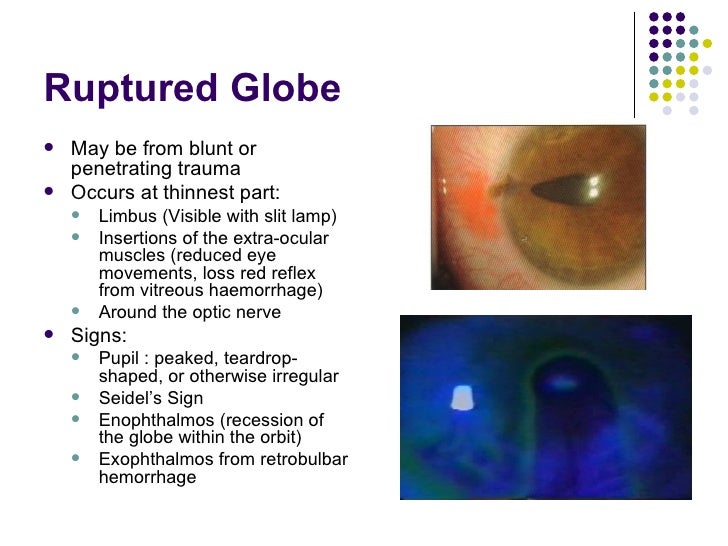 Ruptured Globe Ruptured Globe