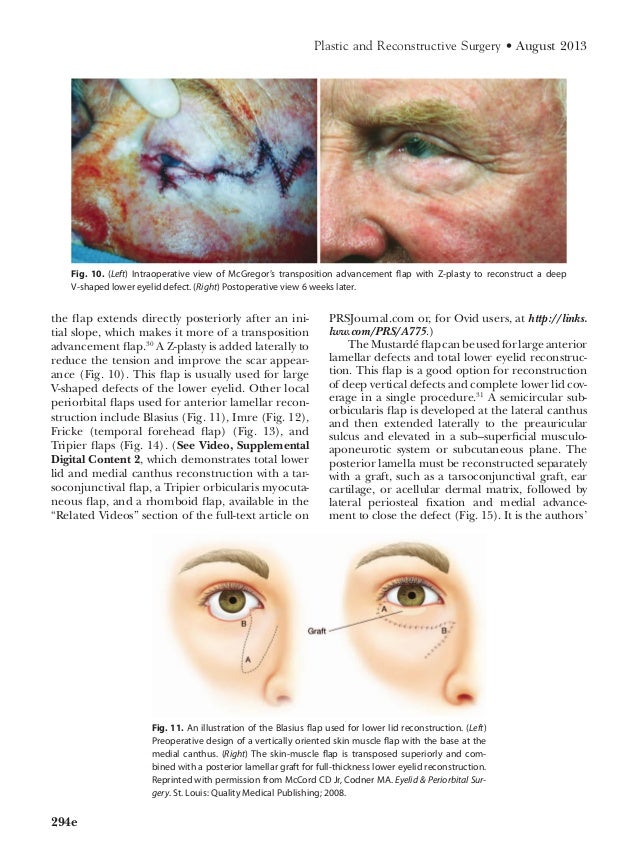 Eyelid Reconstruction CME Article Dr. McClellan