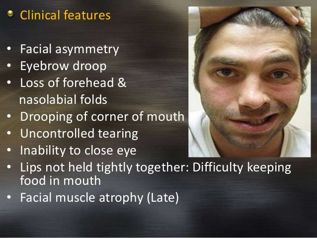 Facial Muscle Paralysis 60