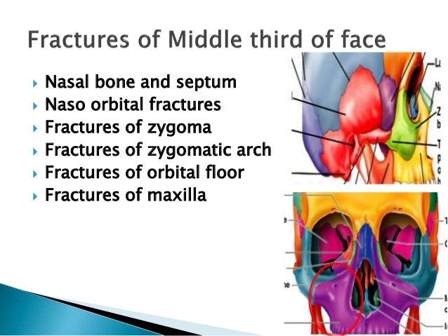 Facial trauma and oroantral fistula