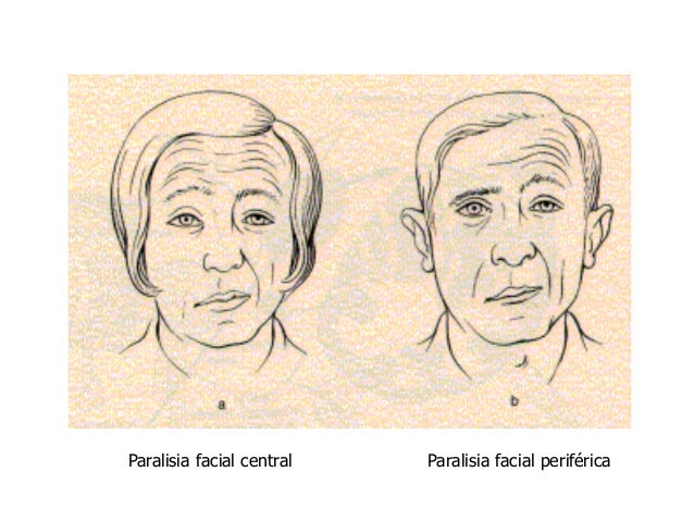 Facial paralysis diagnosis