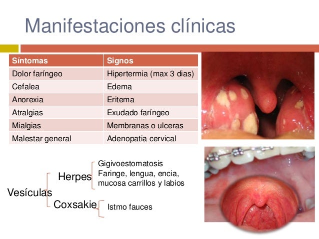 El gel de la psoriasis