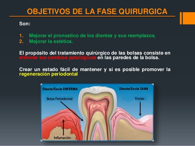 Fases del tratamiento periodontal, Carranza, Periodontología clínica…