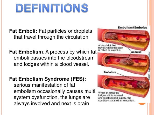 Fat Embolism Syndrome | Bone and Spine