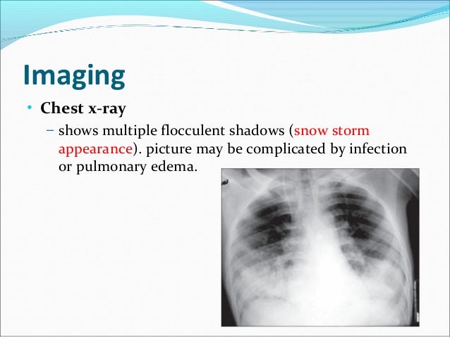 Fat embolism syndrome