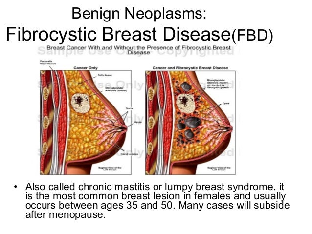 asian fuck nurse who discovered fibrocystic breast disease