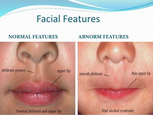 Facial Features Of Fas 52