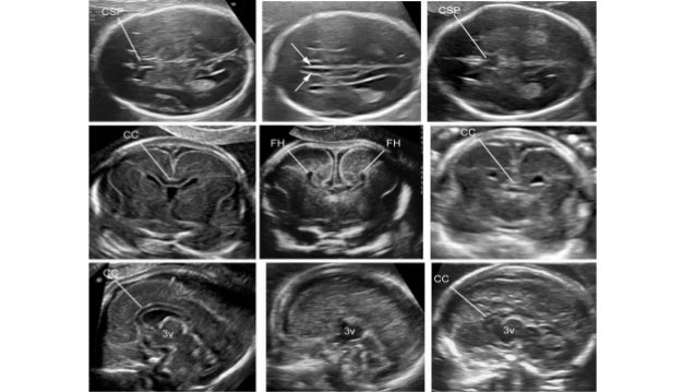 Fetal brain anomalies