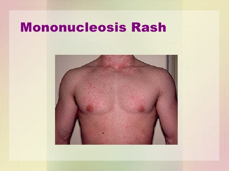 Mono and amoxicillin?? - Mononucleosis Forum - eHealthForum