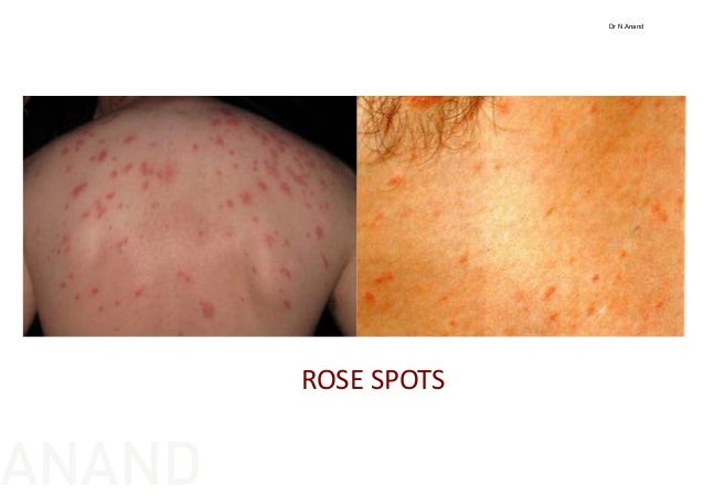 Roseola Rash - Pictures, Treatment, Symptoms, Causes ...