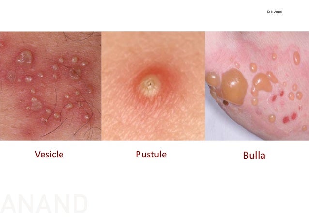 Approach to the patient with pustular skin lesions