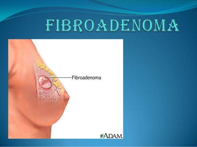 fibroadenoma of breast