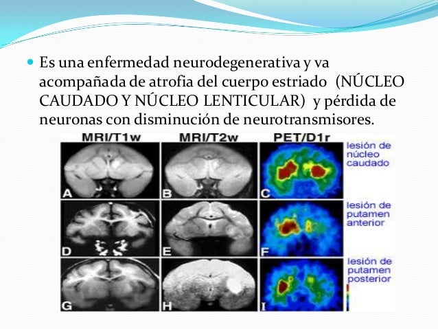 ENFERMEDAD DE HUNTINGTON, FIBROSIS QUISTICA, FENILCETONURIA ENFERMEDAD DE HUNTINGTON, FIBROSIS QUISTICA, FENILCETONURIA