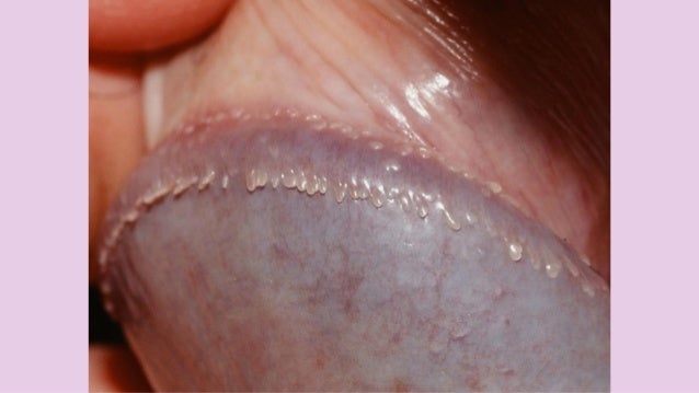 Fibrous Papule of the Nose - Sanova Dermatology