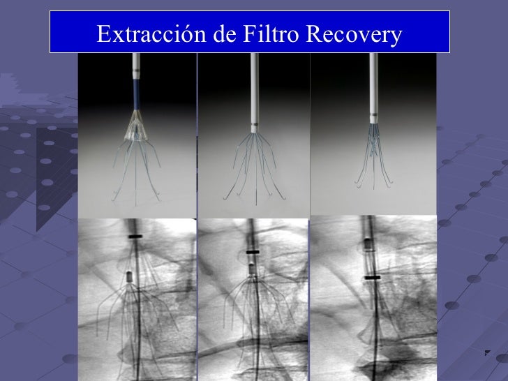 Filtro de vena cava