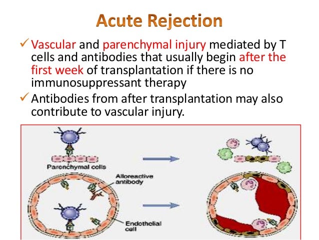 Kidney Transplant Tissue Matching