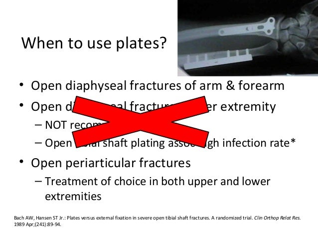 form open fracture 3d