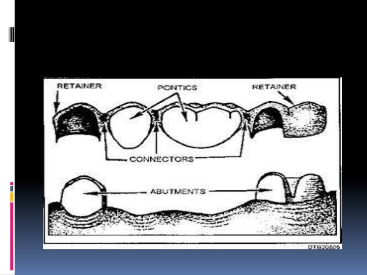 Fixed prosthodontics components