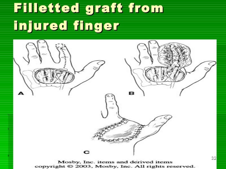 Flaps in orthopaedics