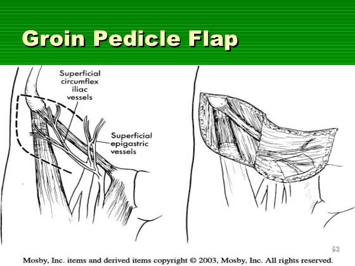 Flaps in orthopaedics