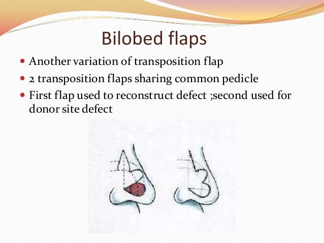 Flaps In Plastic Surgery